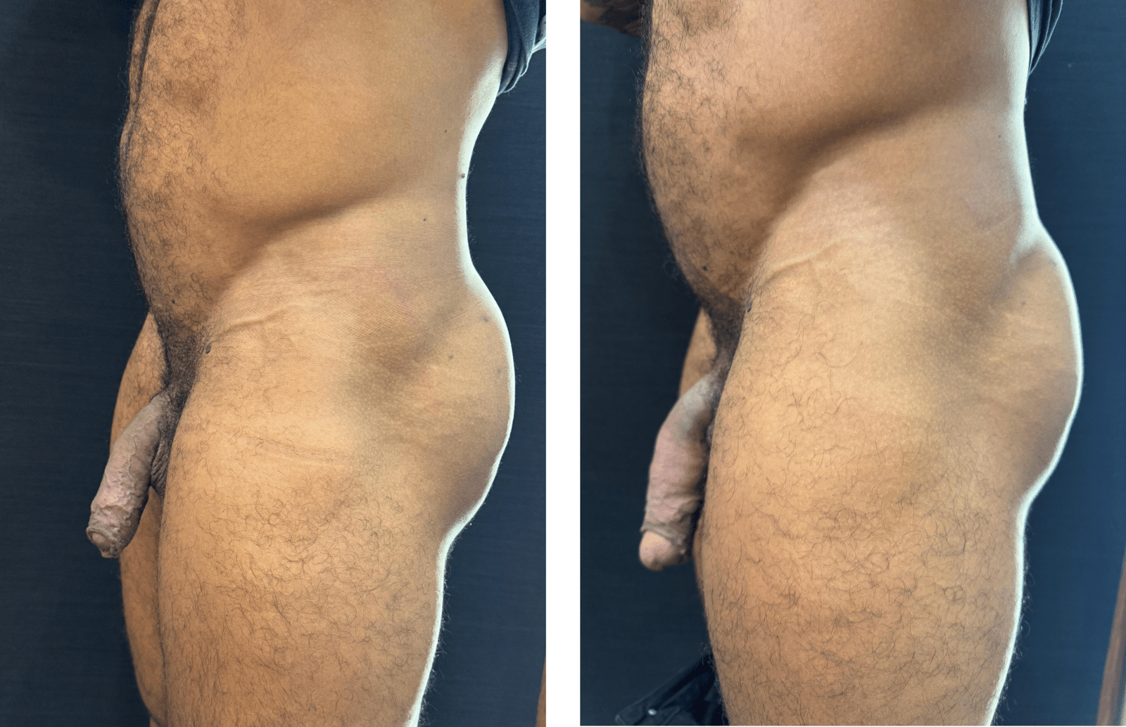 aumento peniano antes e depois