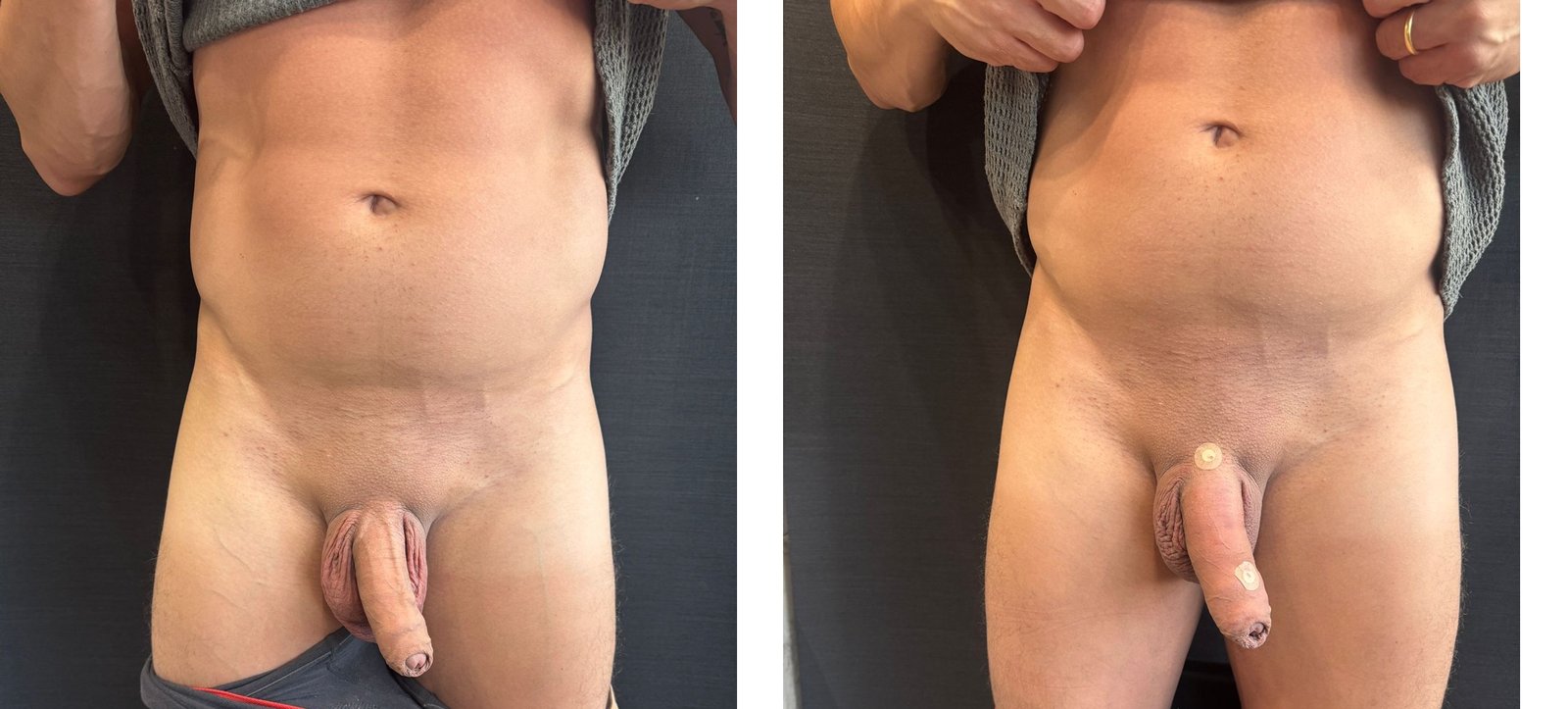 AUMENTO PENIANO 1204 - ANTES E DEPOIS