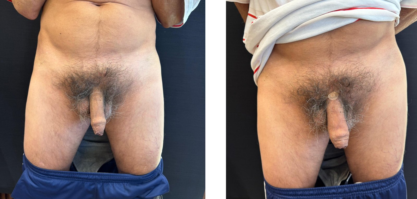 AUMENTO PENIANO - ANTES E DEPOIS