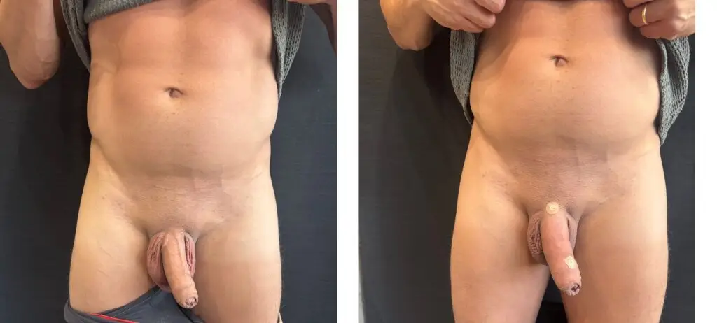PRIME MEDICAL CENTER - AUMENTO PENIANO 1204 - ANTES E DEPOIS