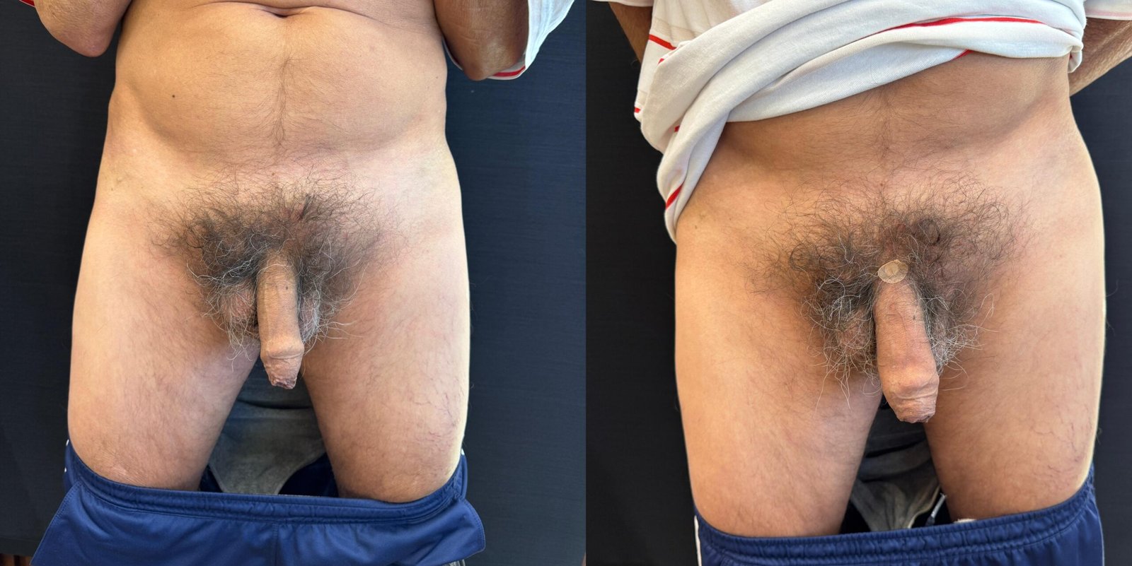 PRIME MEDICAL CENTER - AUMENTO PENIANO - ANTES E DEPOIS