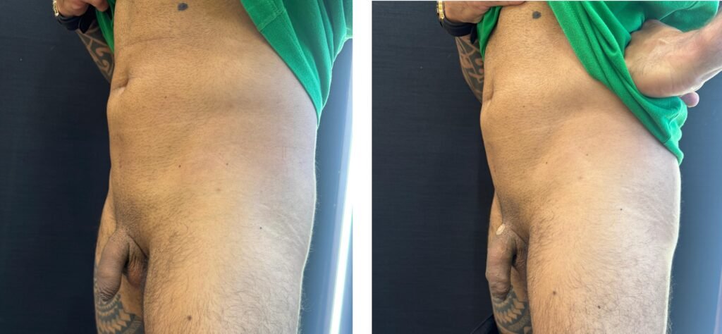 PRIME MEDICAL CENTER - AUMENTO PENIANO - ANTES E DEPOIS
