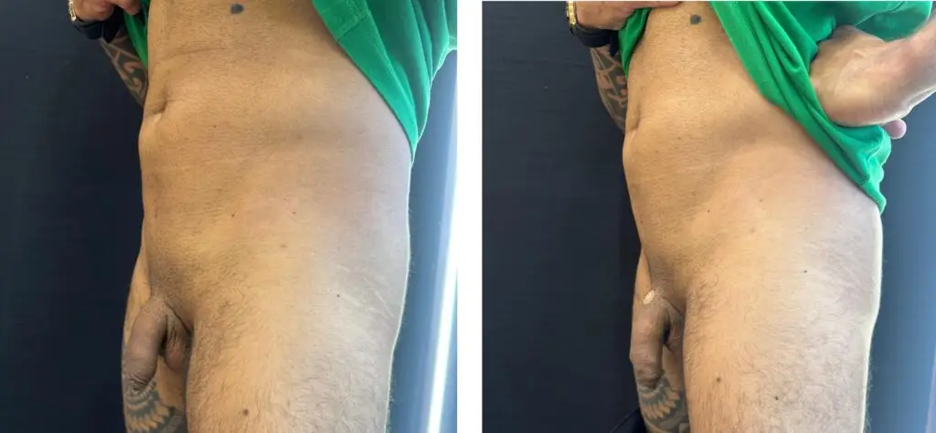 PRIME MEDICAL CENTER - AUMENTO PENIANO - ANTES E DEPOIS