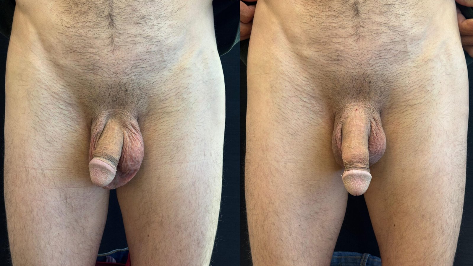 AUMENTO PENIANO - ANTES E DEPOIS