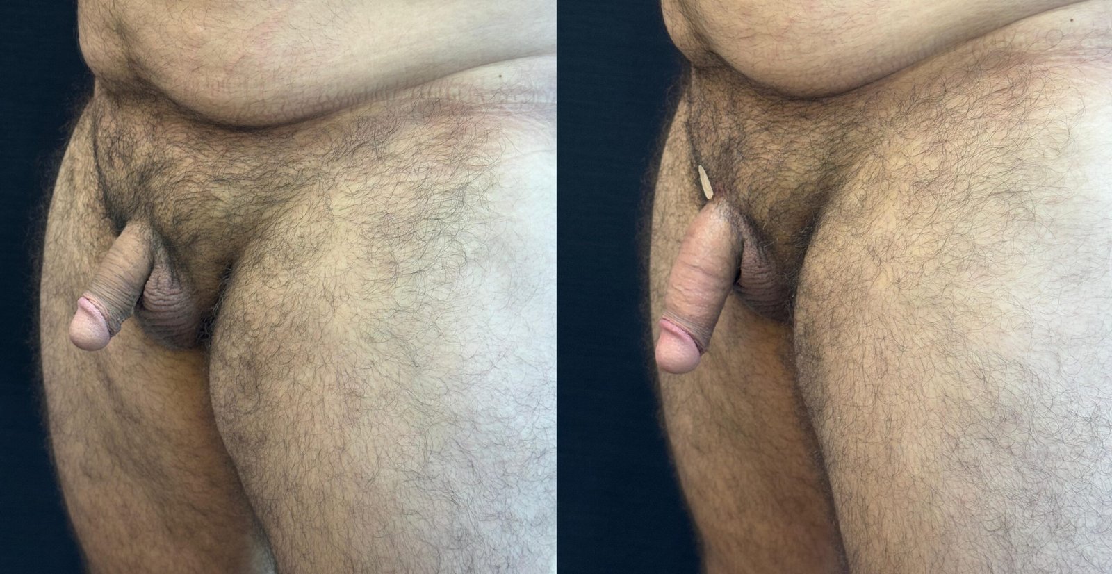 aumento peniano - antes e depois