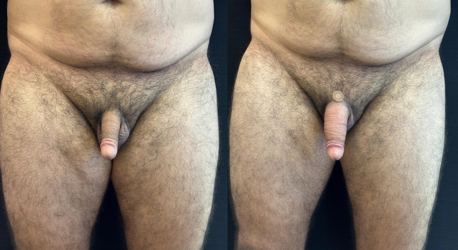 aumento penianoa - antes e depois